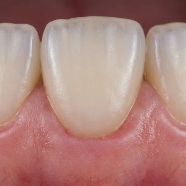 Veneers
