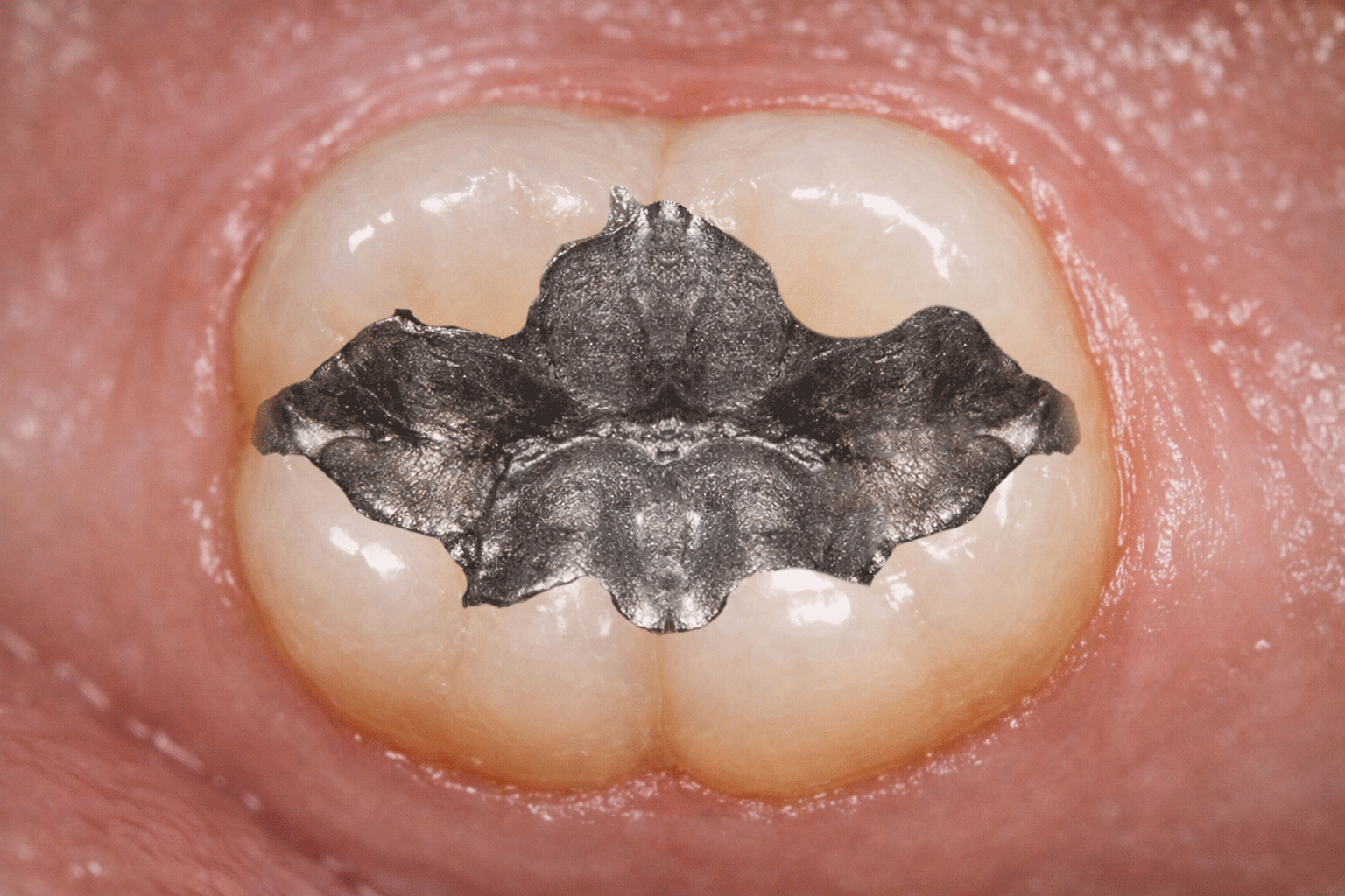 Dental surface buildup before professional cleaning